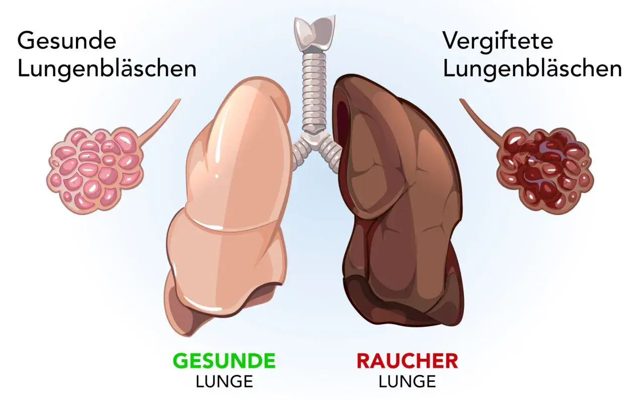 Vergleich: gesunde Lunge (rosa Lungenbläschen) vs. Raucherlunge (dunkle, verfärbte Lungenbläschen).
