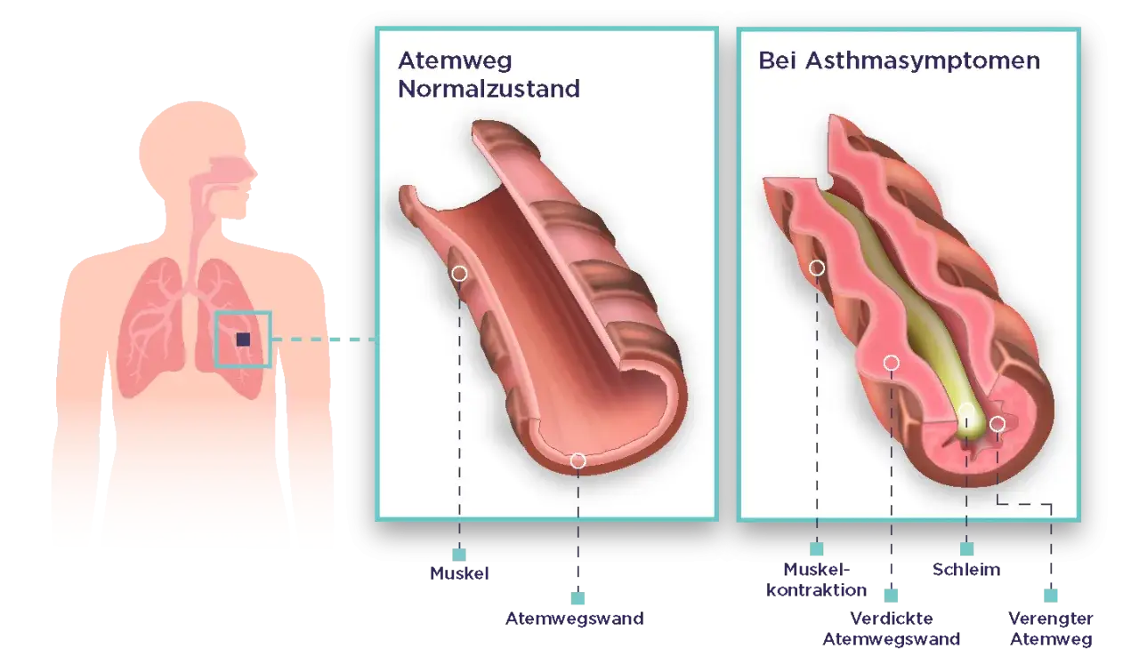 Vergleich von Atemwegen: Normalzustand vs. Asthma. Bei Asthma symptomen sind die Atemwege verengt durch Muskelkontraktion, verdickte Wände und Schleim.