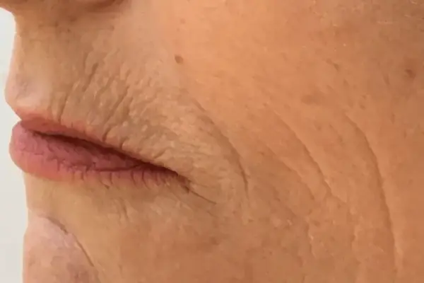 Nahaufnahme der Lippen und der Haut einer älteren Person mit tiefen Falten, die auf die Auswirkungen des Rauchens hinweisen. Kleine Pickel sind sichtbar.